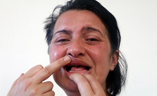 &#039;Bembeyaz dişlerim olsun&#039; istedi, hayatı zindan oldu