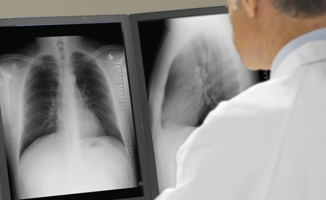 Akciğer röntgeni hayat kurtarıcı olabilir