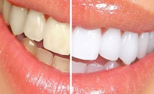 Dişlerde renk değişimine dikkat edilmeli!