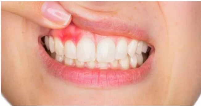 Diş apsesine ne iyi gelir?