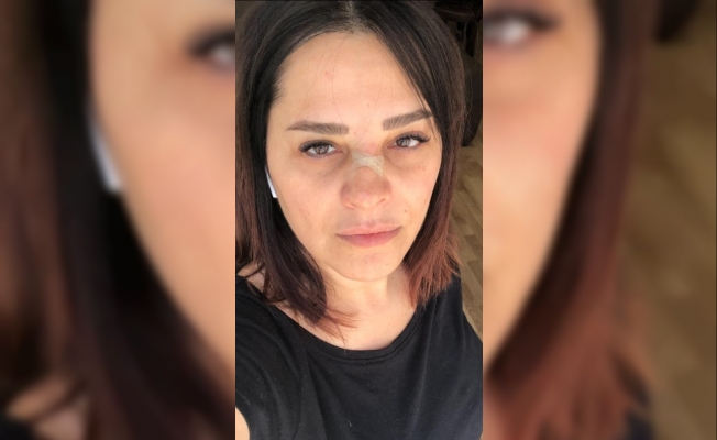 Ünlü şarkıcı Reyhan Karaca’nın burnu kırıldı