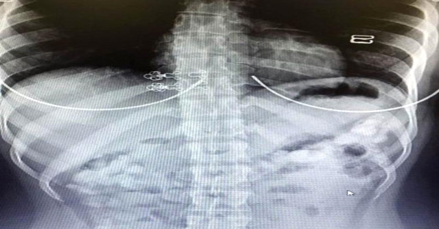 İç organlarından uyuşturucu çıktı